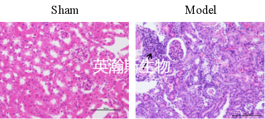 肾盂肾炎 (1).png