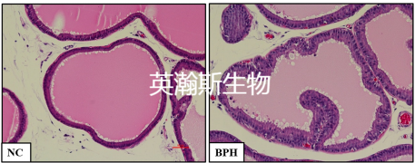 前列腺增生.png